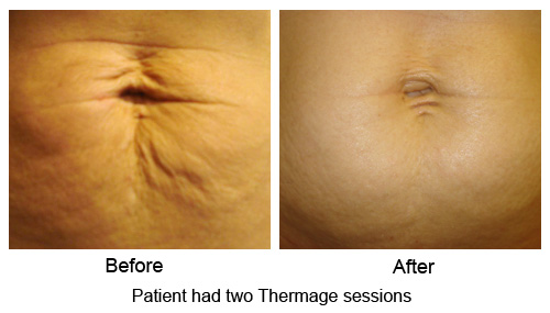 Thermage Tummy for Mommy Makeover